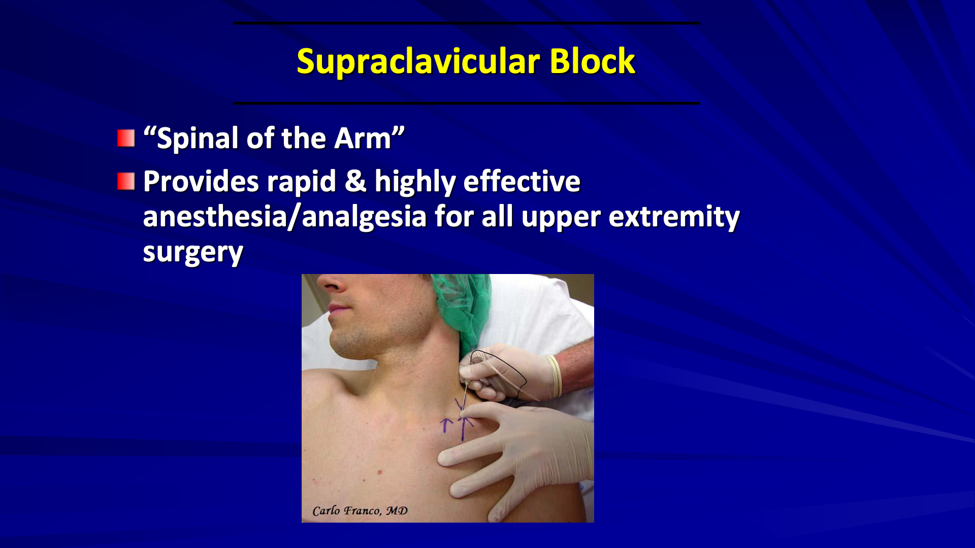 Supraclavicular Brachial Plexus Block For Arteriovenous Hemodialysis