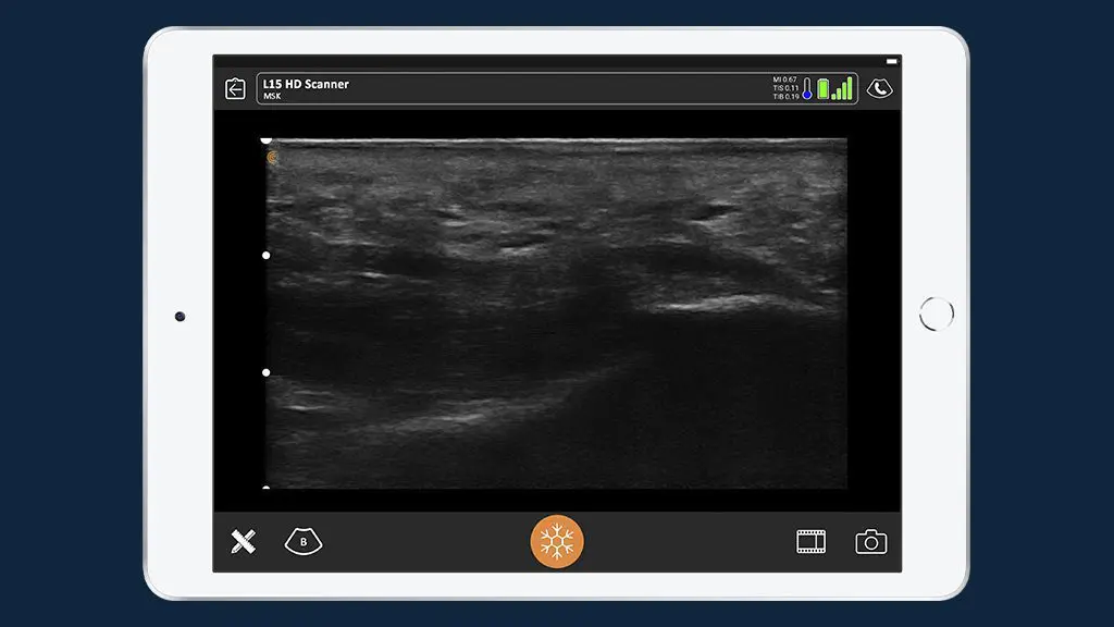 Podiatrist Provides On-the-Spot Diagnosis and Treatment Thanks to Clarius Ultrasound