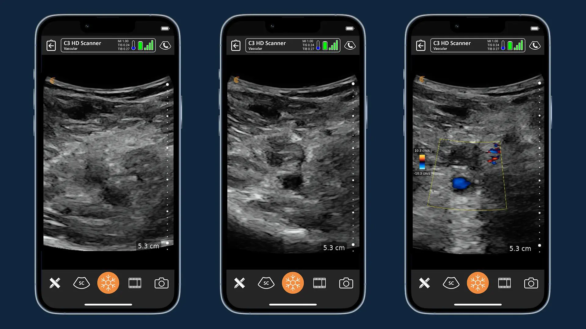 Confirm COVID-Induced Venous Thromboembolic Disease with Handheld Ultrasound copy