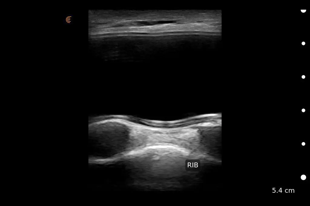 Breast Implant Rib