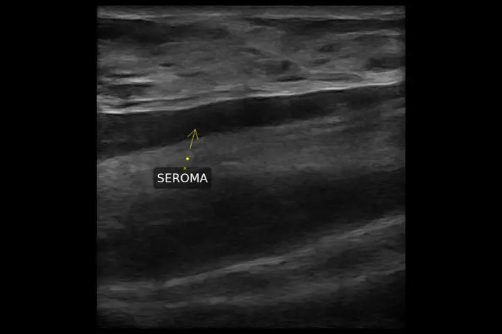 Breast Seroma