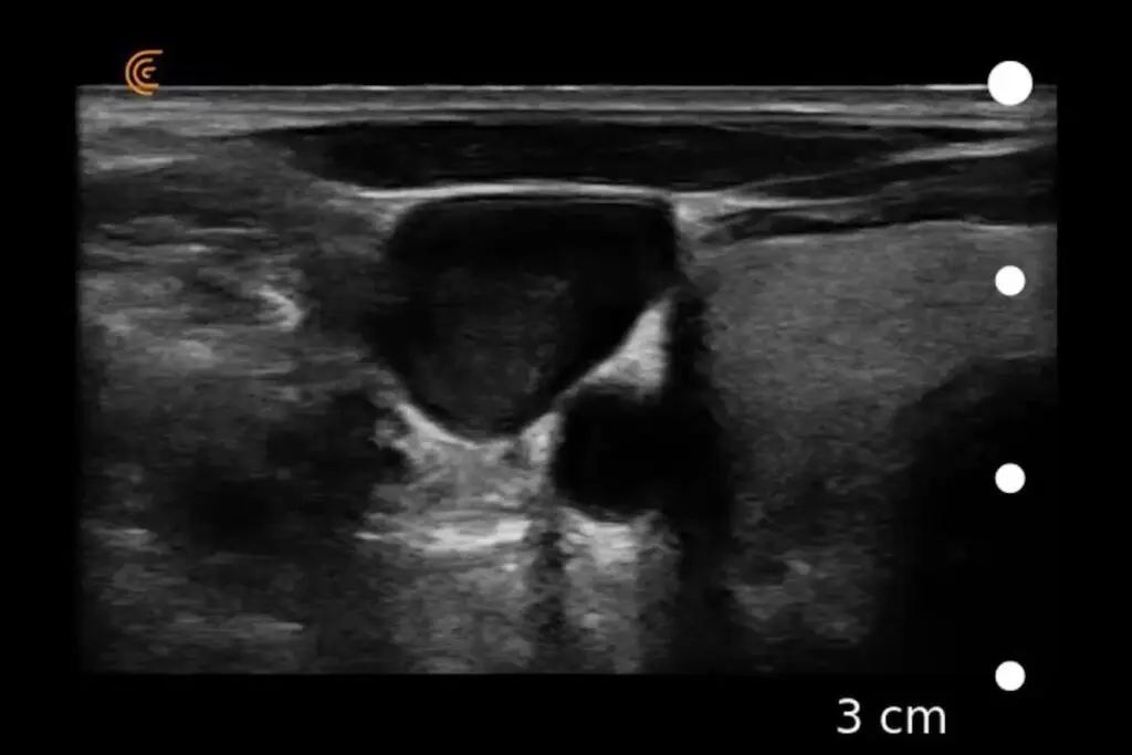 IJ Thrombus