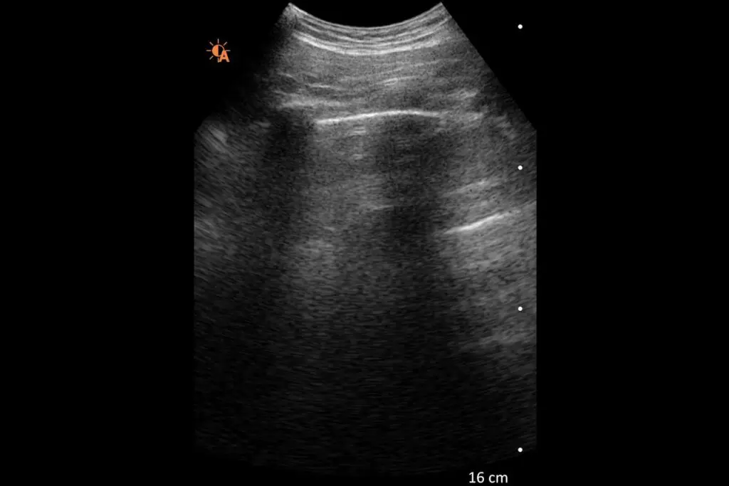 Normal Lung