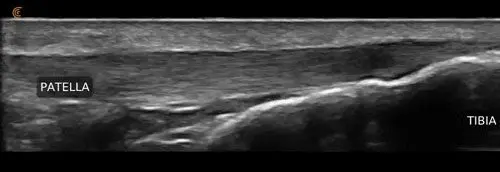 Patellar Tendon