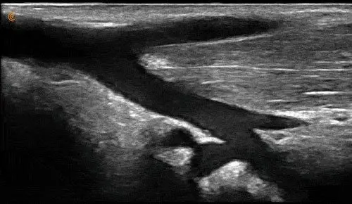 Nerve-Basilic-Vein