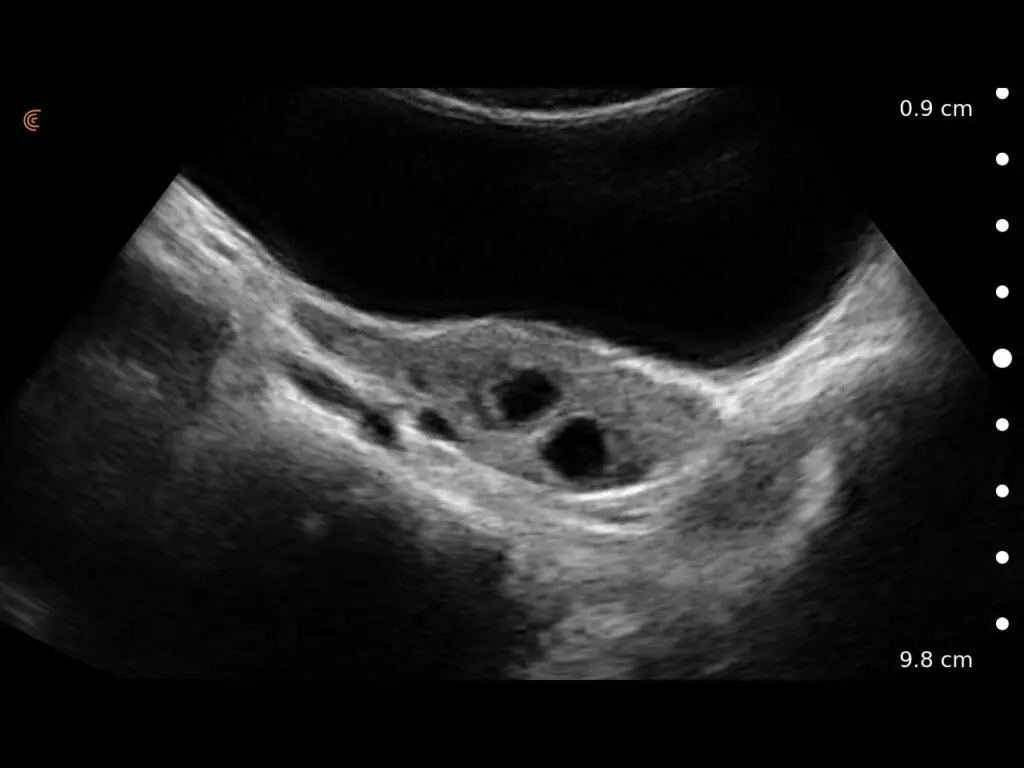 Ovary