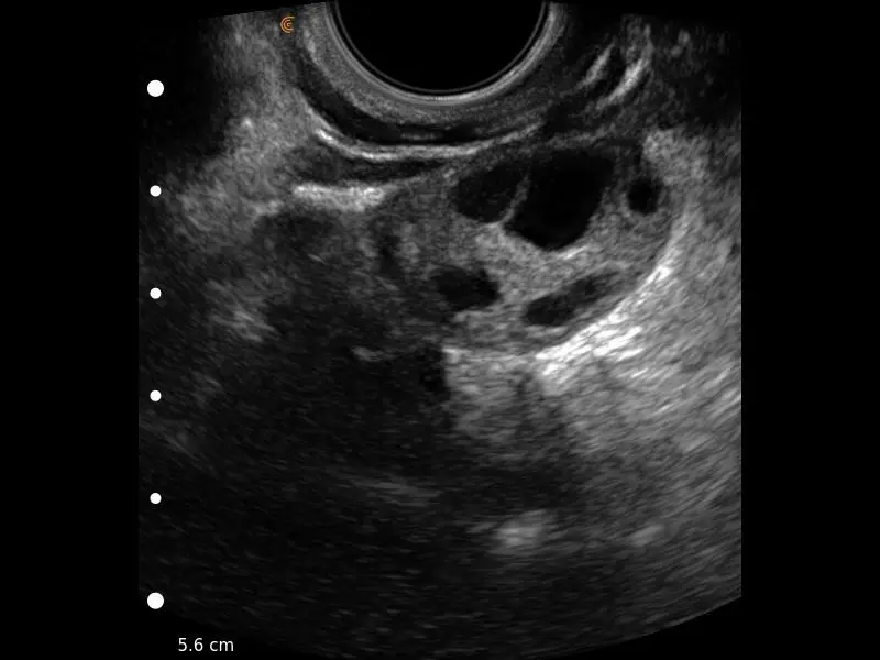 Ovary