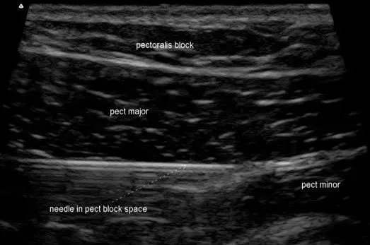PEC Block