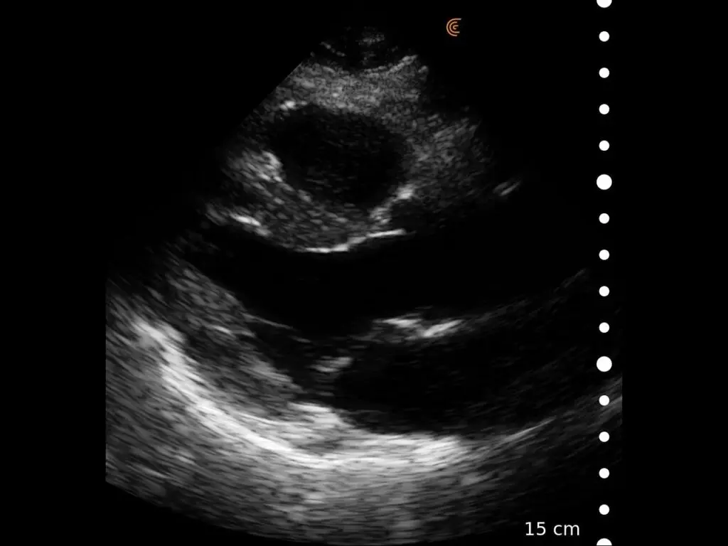 PLAX Heart
