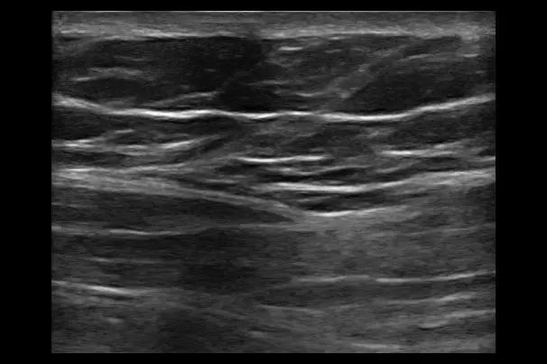 Anterior Rectus Sheath