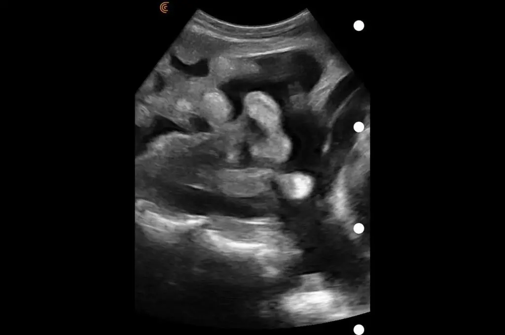 Ascites