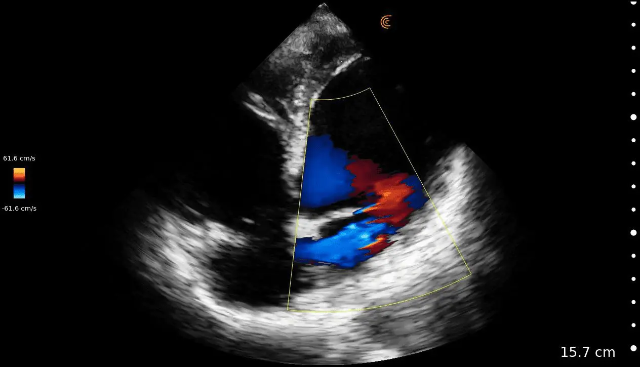 4 CH MR Cardiac