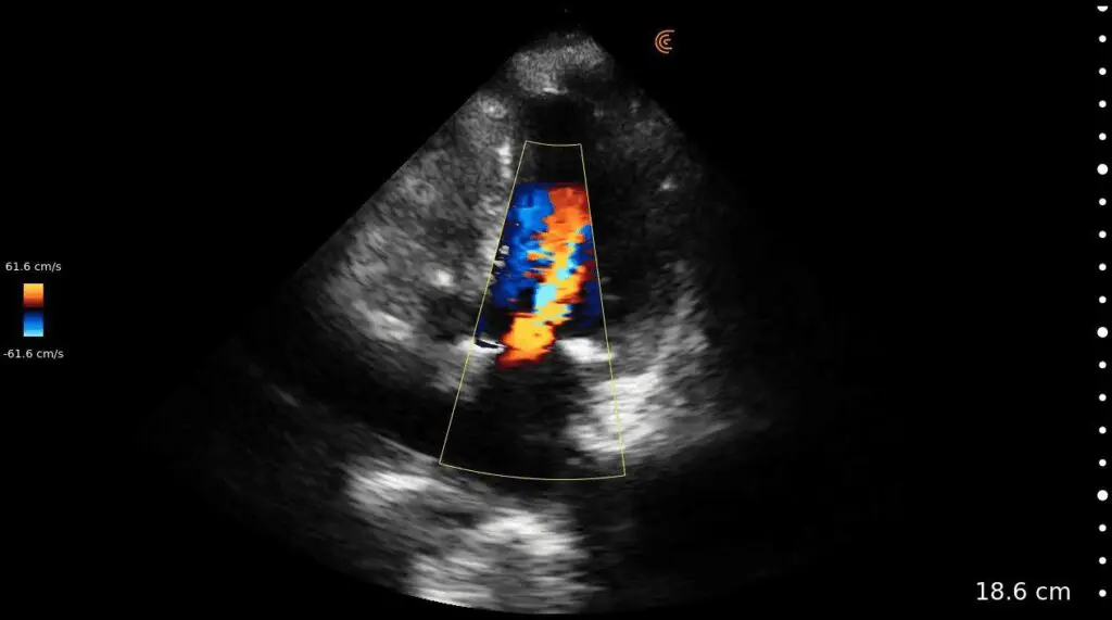 4CH Mitral Stenosis