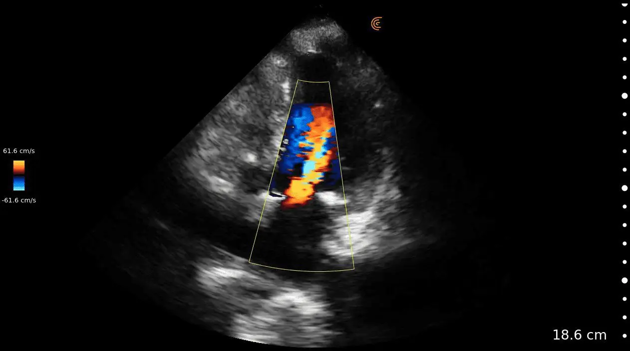4CH Mitral Stenosis