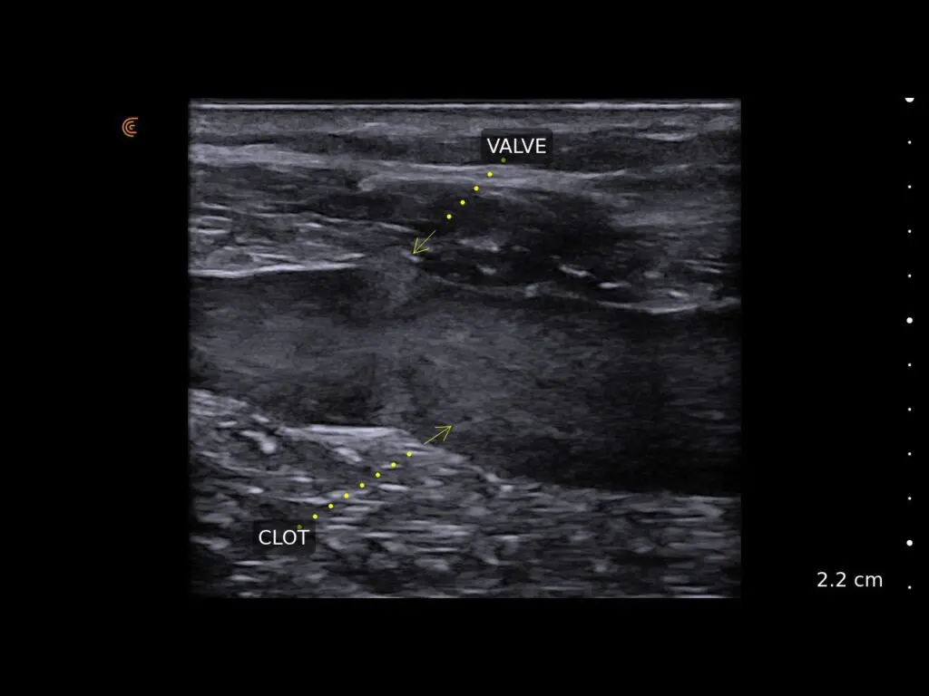 DVT clinical image