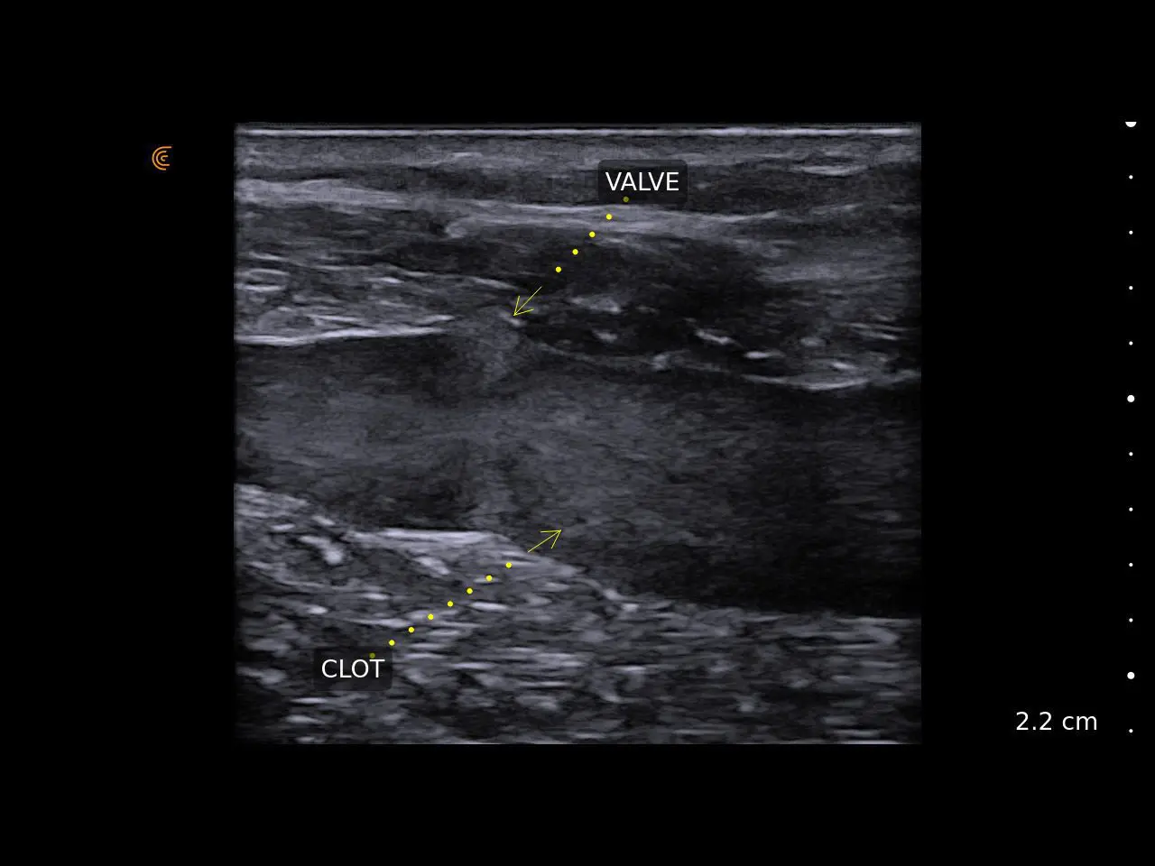 DVT clinical image