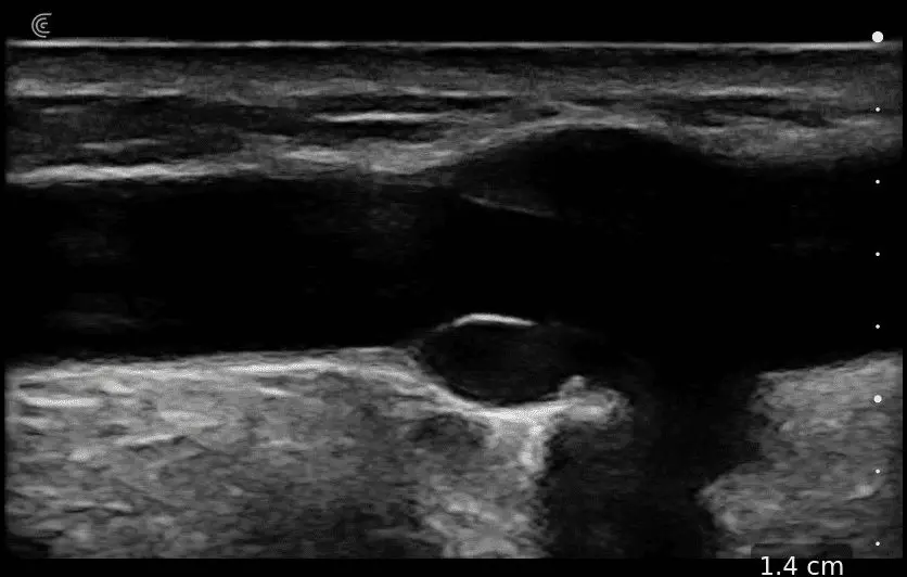 Med Cubital Vein with Valve