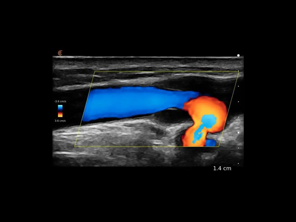 Median Cubital Vein Color