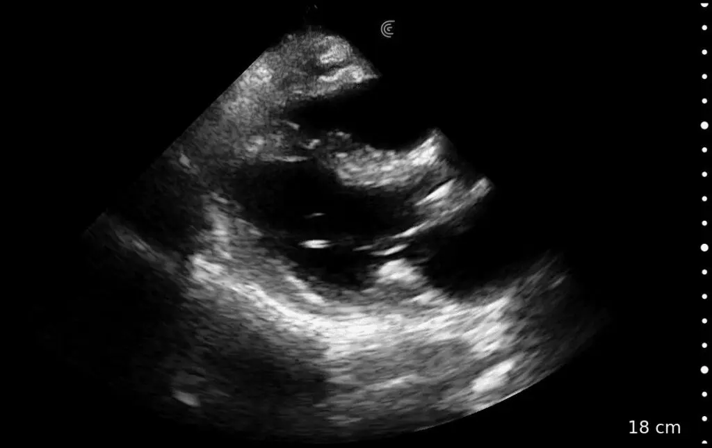 Mitral Annular Calc