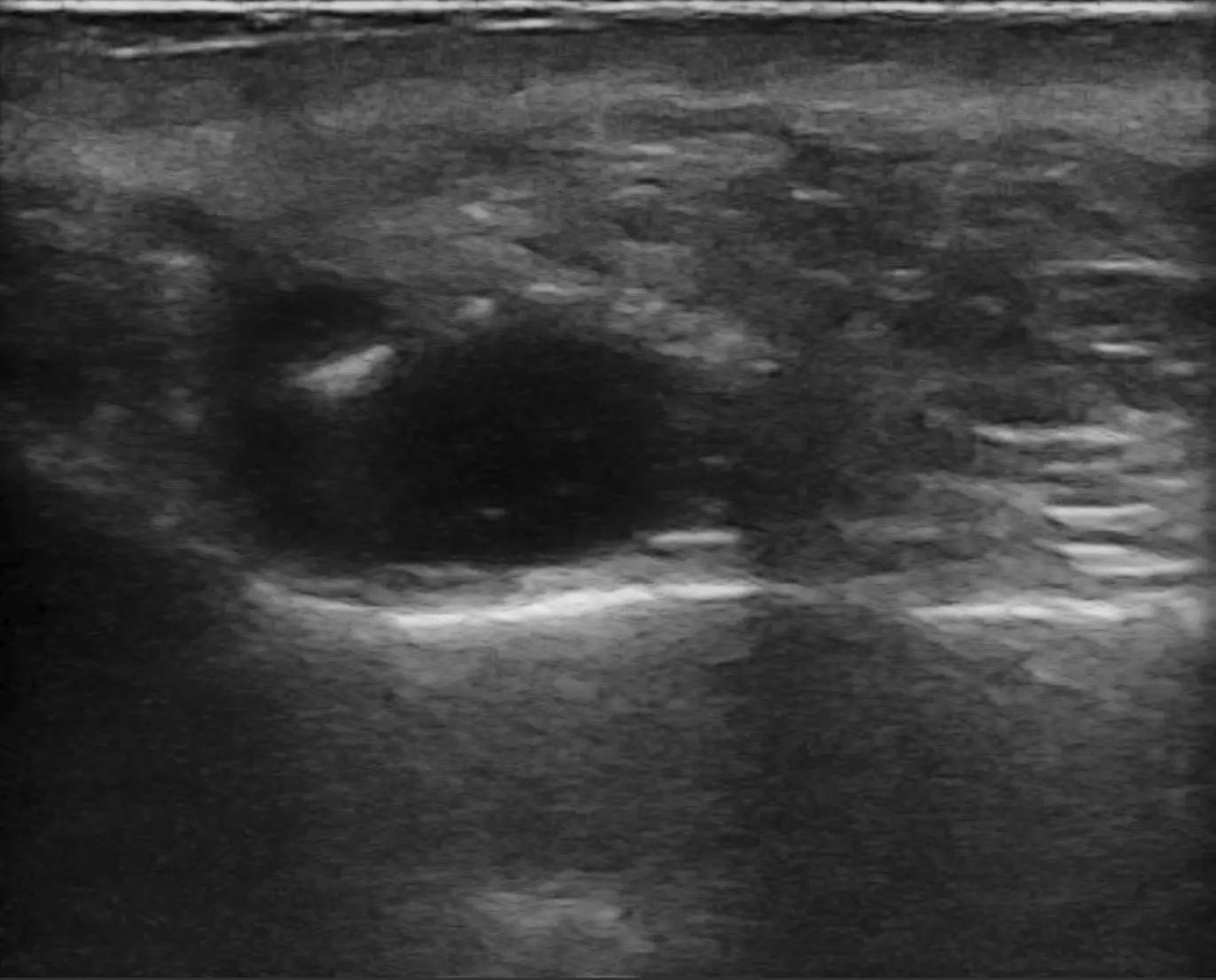 Piriform Filler