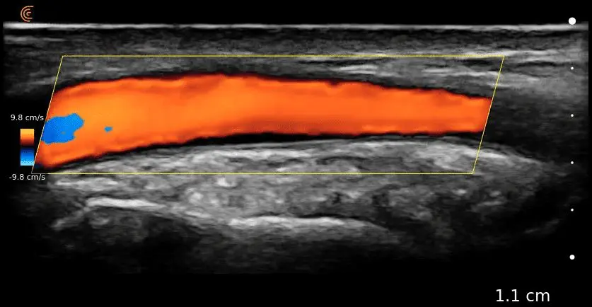 Radial Artery Color