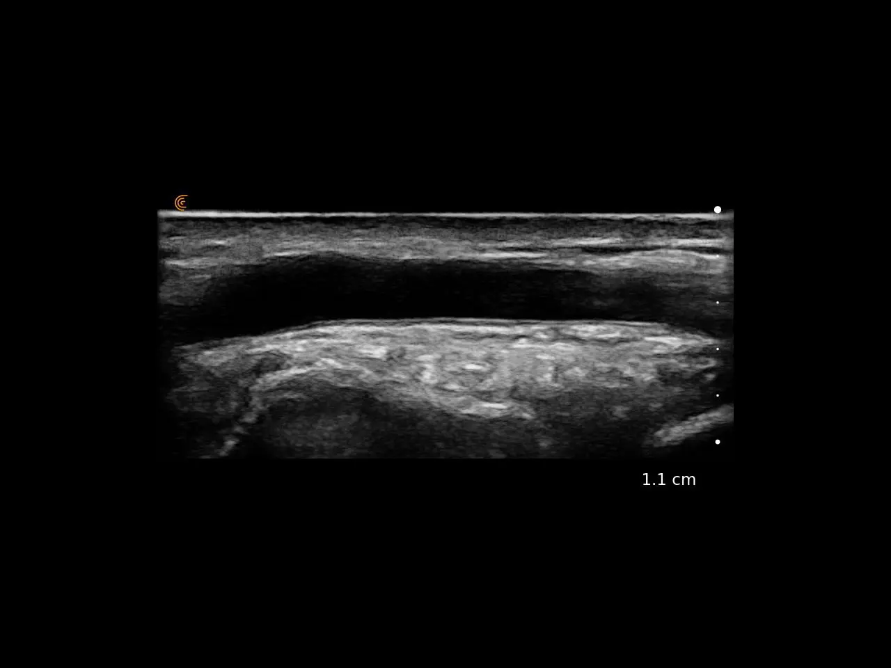 Radial Artery