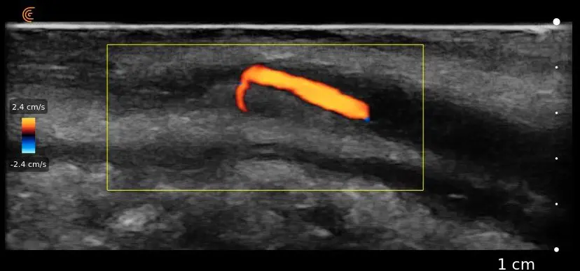 Labial Artery