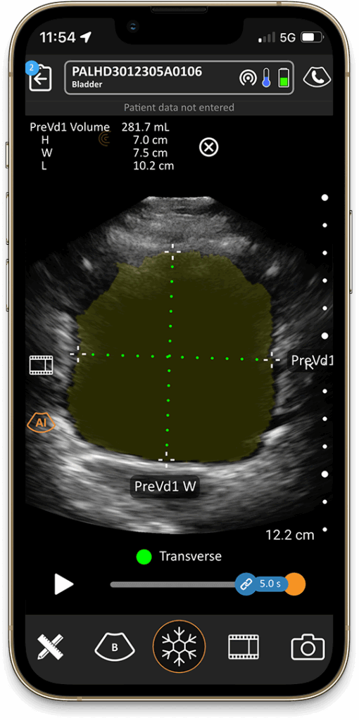 Bladder AI provides rapid, automated bladder volume measurements, aiding in the assessment and management of urinary retention, and reducing the risk of infections associated with unnecessary catheterization.