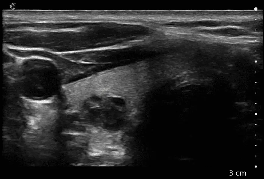 Thyroid Nodule