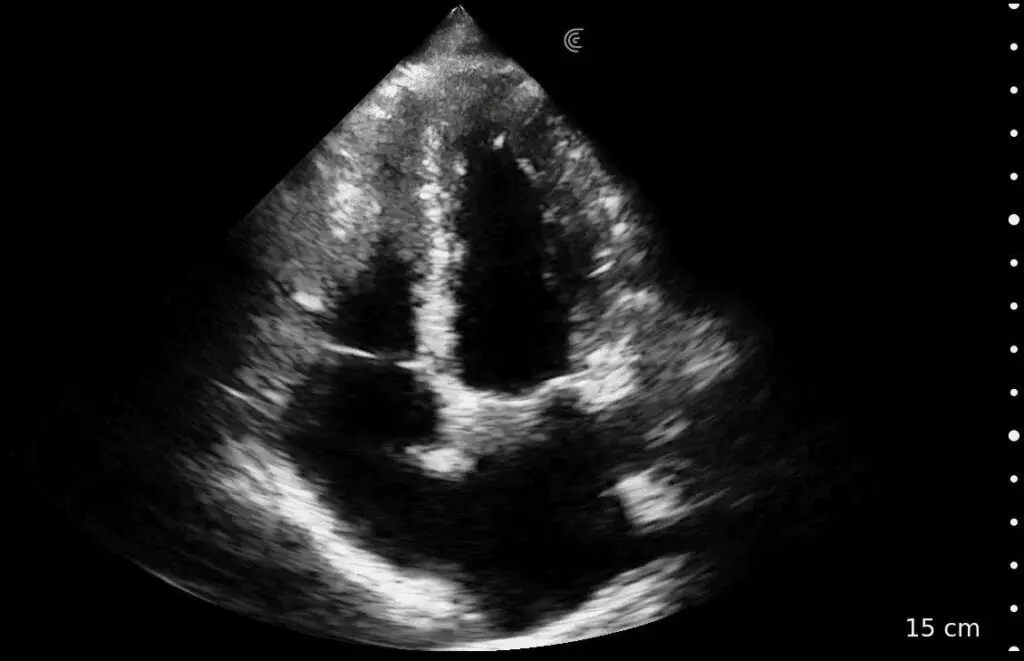 Cardiac_CC_Apical 4Ch_PA_HD3_Tablet_PNG