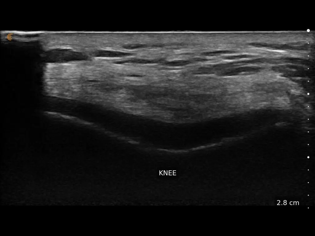 Knee Cartiledge