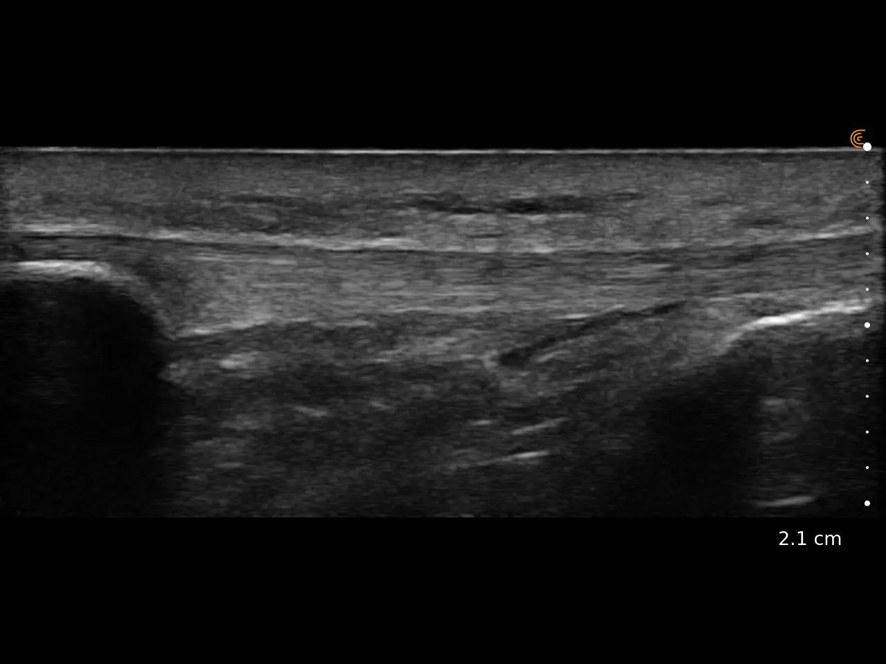Patellar Tendon Insert