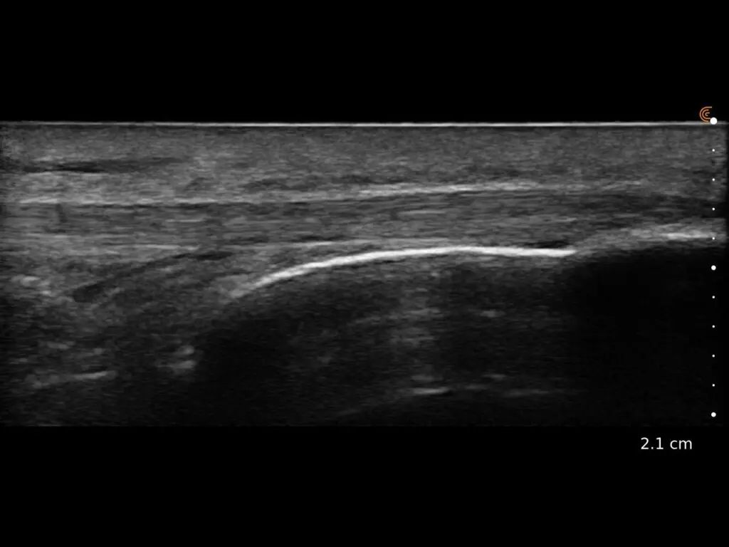 Patellar Tendon Tib Insert