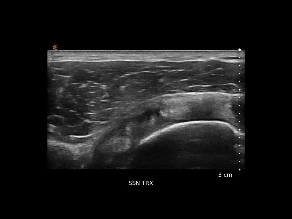 RTC Tendosis