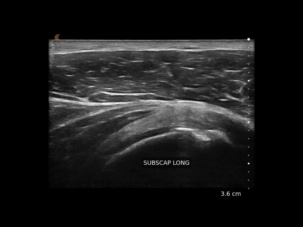 Subscap Tendon Long