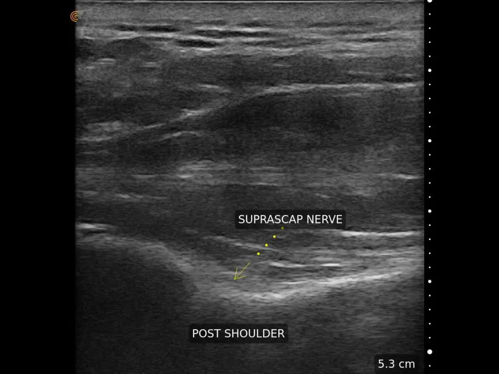 Suprascap Nerve L15