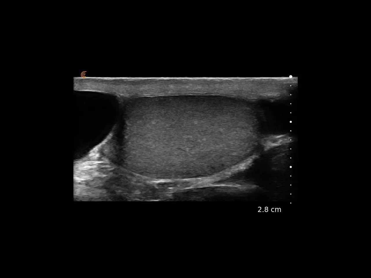 Testicle with cyst