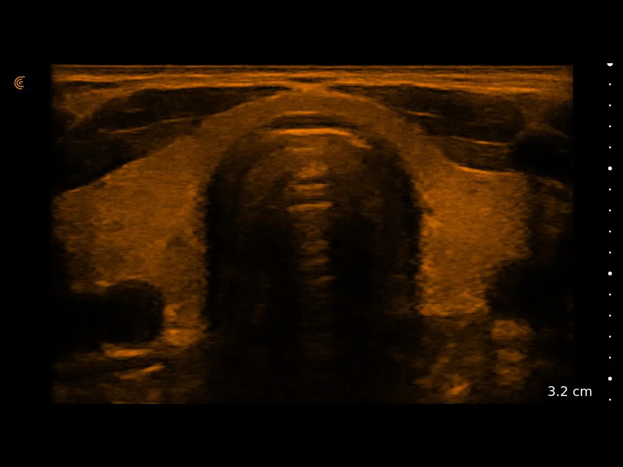 Thyroid Chroma