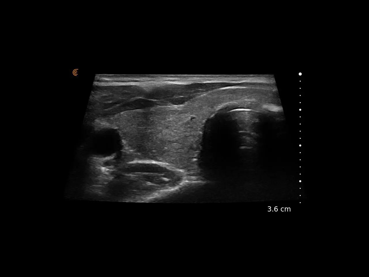 Thyroid Rt Lobe w Trapezoid