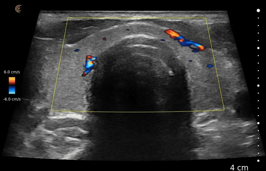 Thyroid w Trapezoid