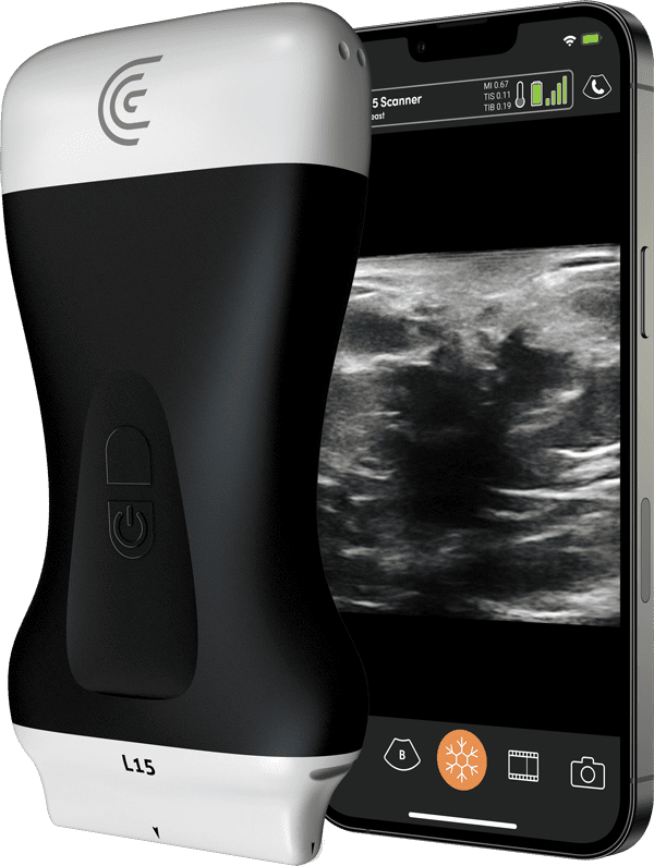 L15 Plastic Surgery Breast Ultrasound Handheld Clarius