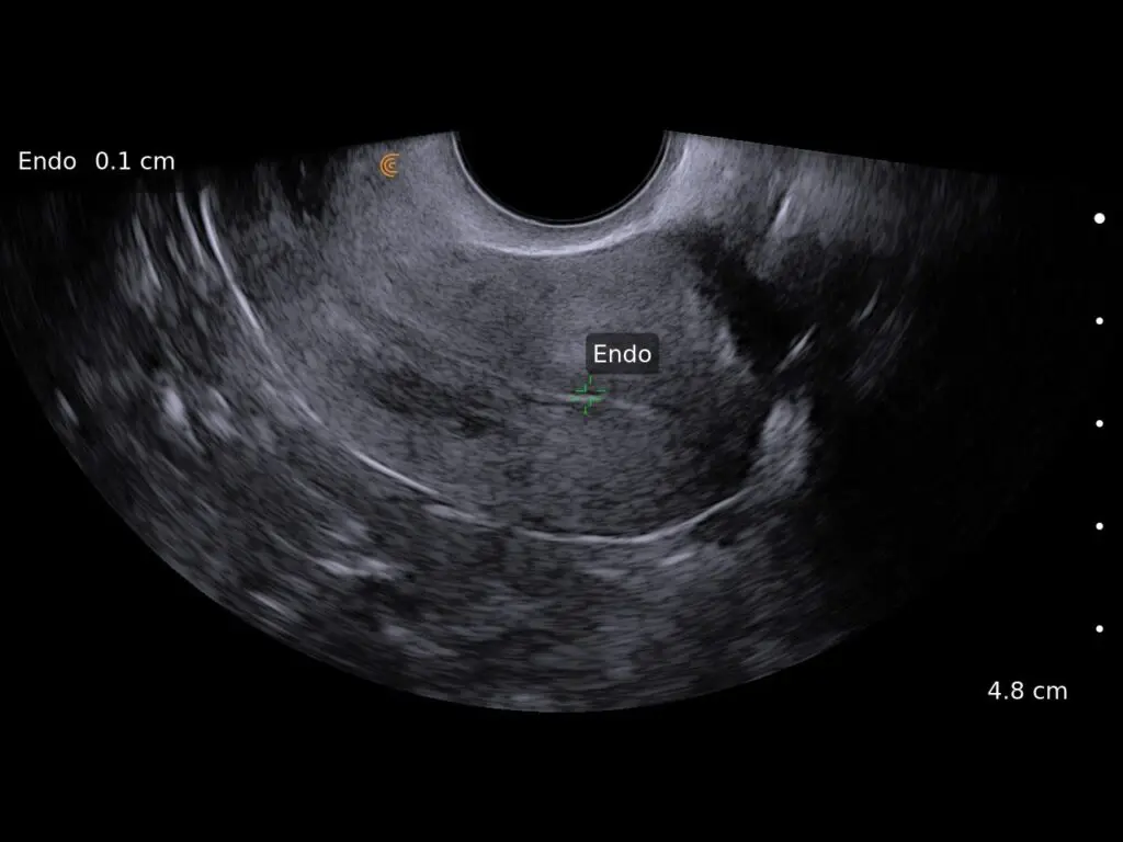 Endometrium