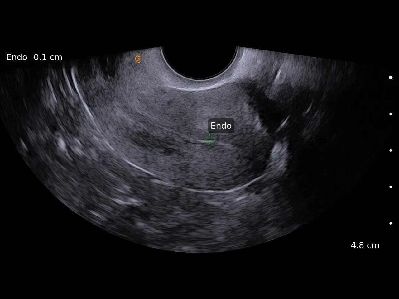 Endometrium
