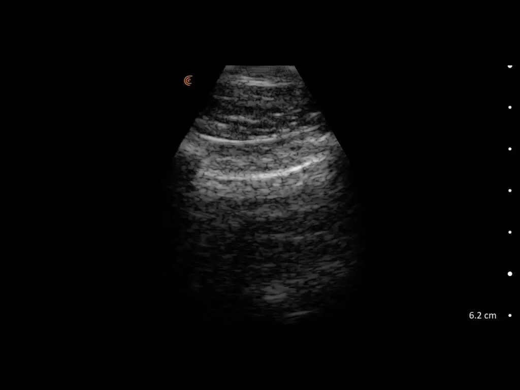 Ultrasound showing lung sliding motion, indicating normal pleural apposition and absence of pneumothorax.