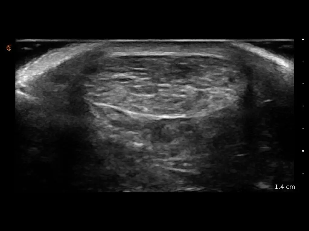 Transverse view of Achilles tendinosis showing thickened tendon and hypoechoic areas