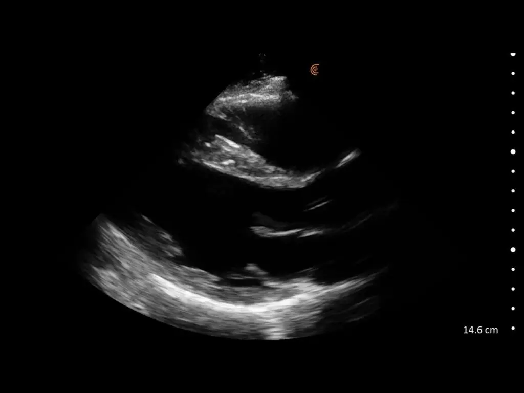 Ultrasound showing a zoomed parasternal long axis (PLAX) view of the heart with detailed visualization of cardiac chambers and valves.