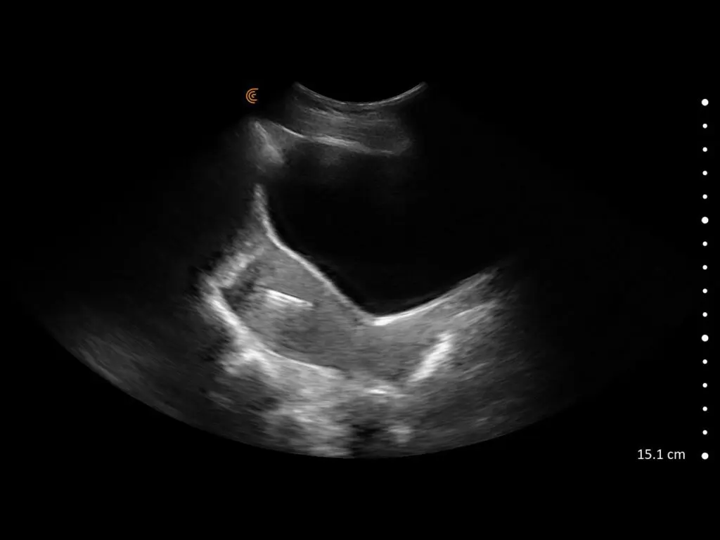 Ultrasound image showing intrauterine device (IUD) placement with clear visualization of uterine anatomy.