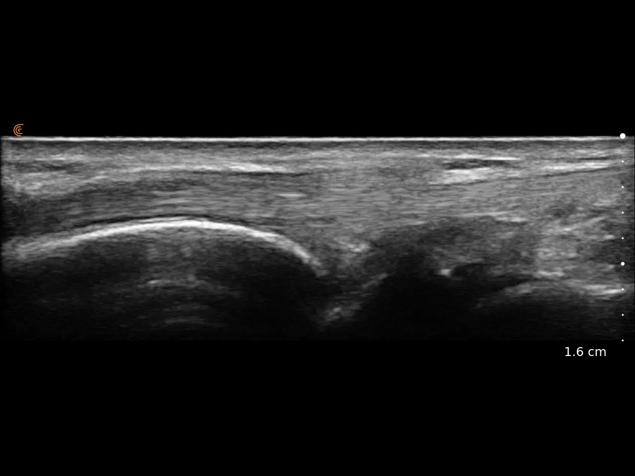 Dorsal Wrist
