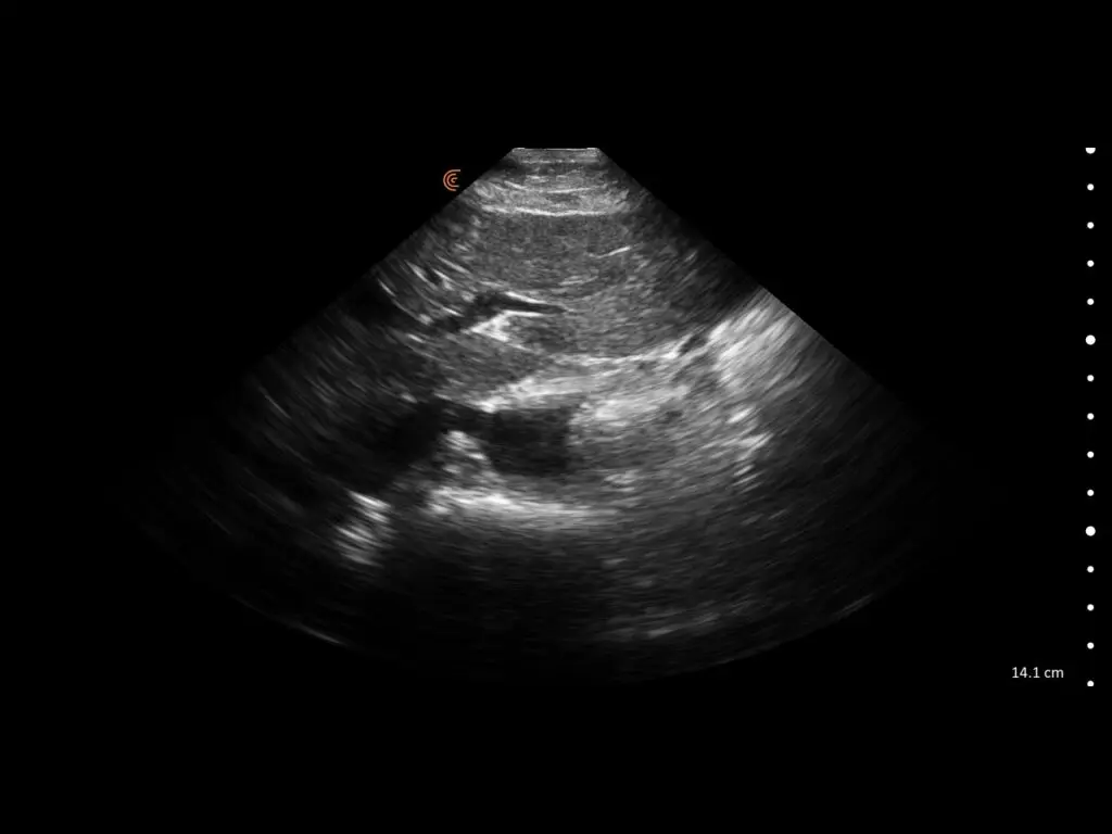 Longitudinal thoracic view of left lower lung lobe showing pleural interface and lung parenchyma