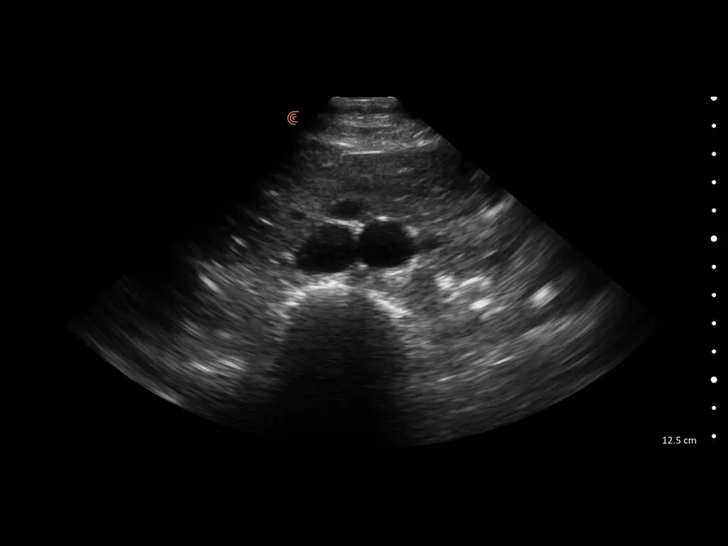 Transverse abdominal view of the aorta showing vessel lumen and surrounding anatomy